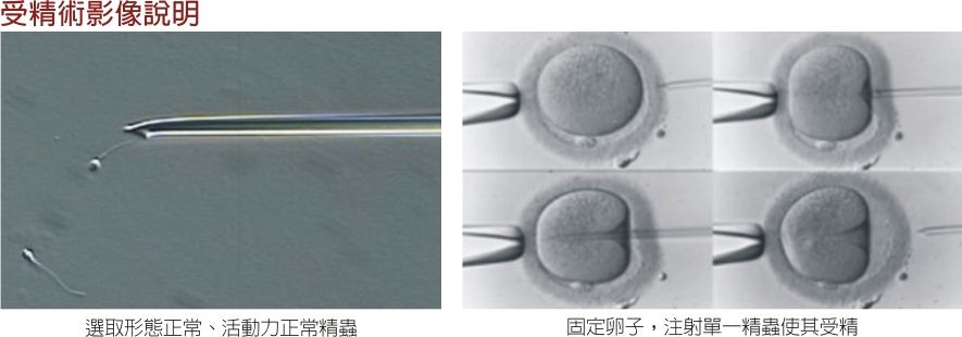 单一精虫显微受精术(Intra-Cytoplasmic Sperm Injection)