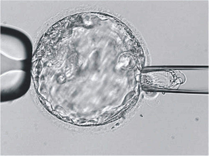 胚胎着床前染色体芯片筛检(PGS)
